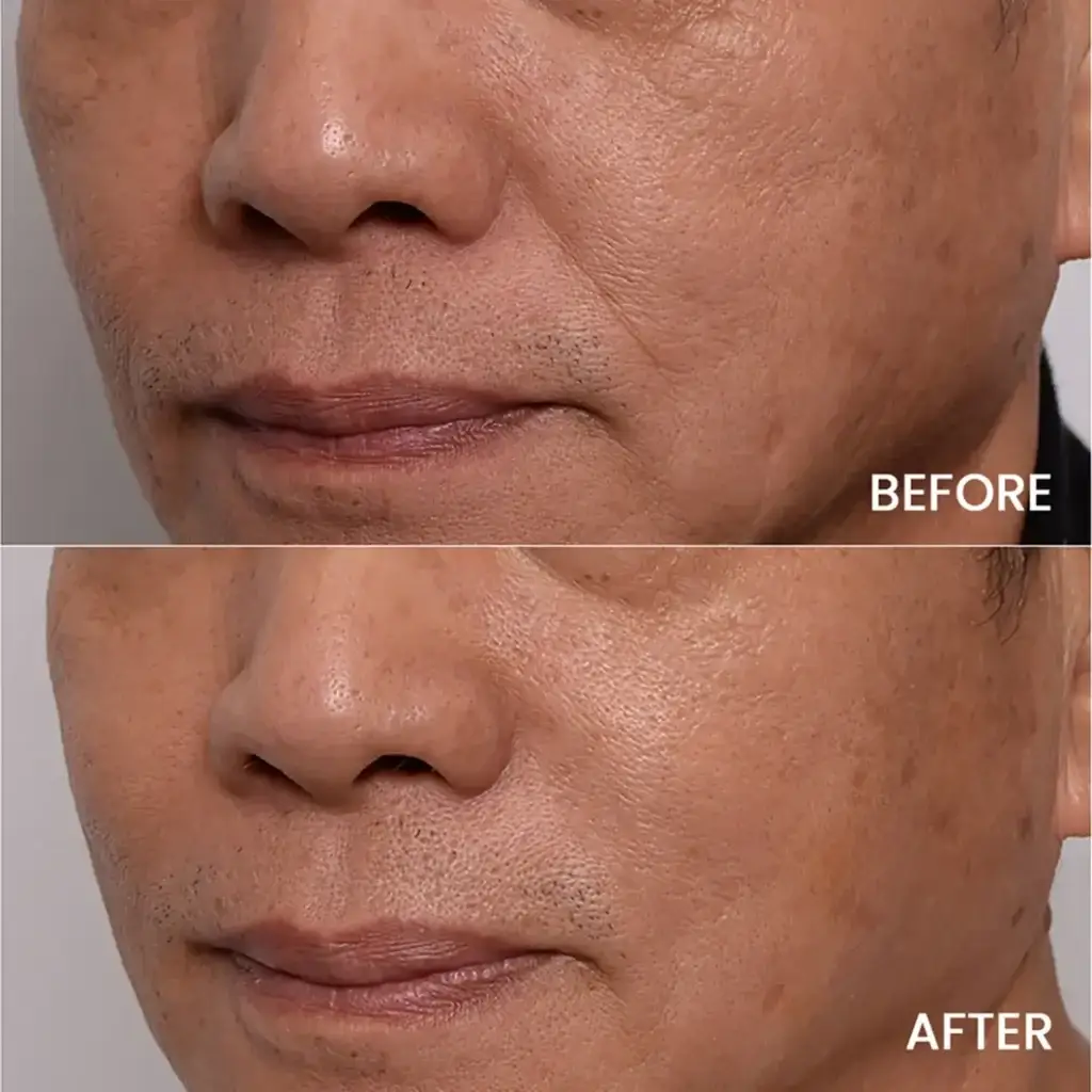 Before and After