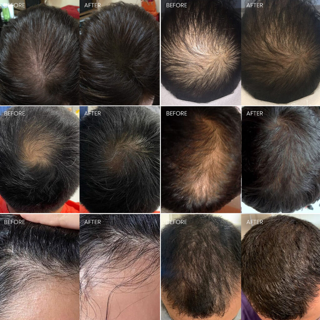 Advertorial Hair Loss Minoxidil